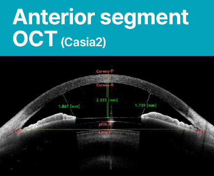 Anterior segment OCT (Casia2)