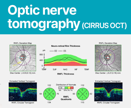 Optic nerve tomography (CIRRUS OCT)