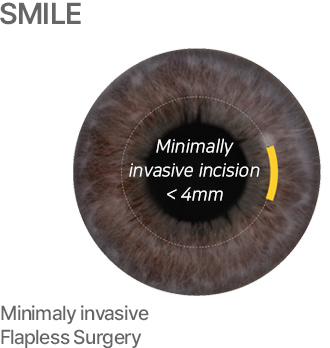 Treatment of horizontal impaction of left mandibu - 굿스마일포럼