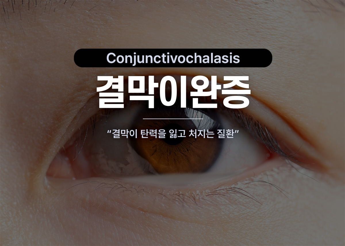 결막이완증